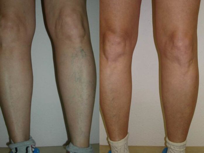 nogi przed i po laserowym leczeniu żylaków
