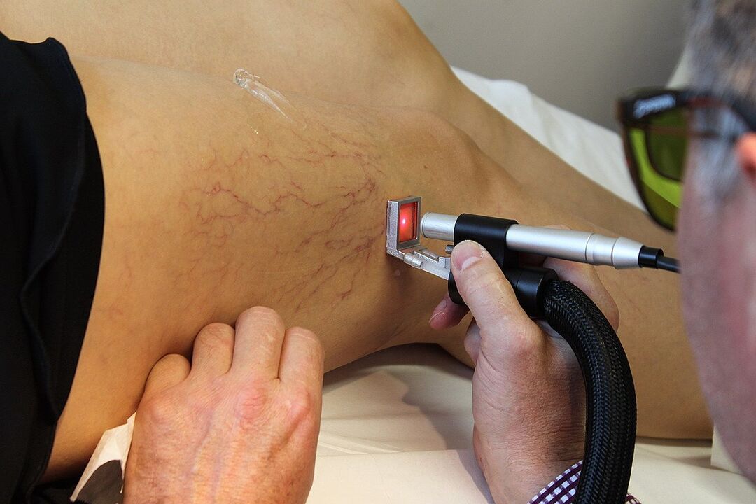 Koagulacja laserowa